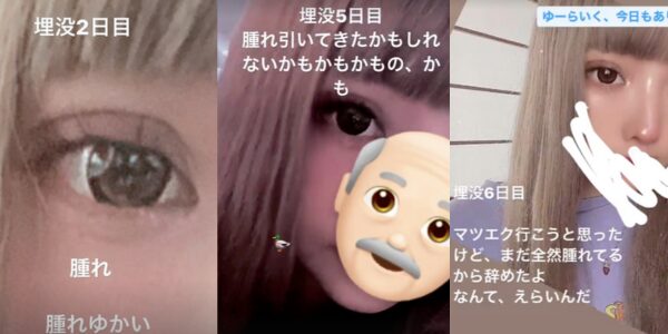 りりちゃんの整形の様子。二重埋没法。