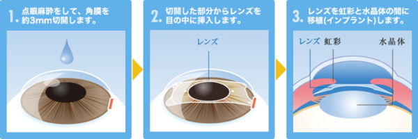 長濱ねるが受けた手術。ICL治療とは。